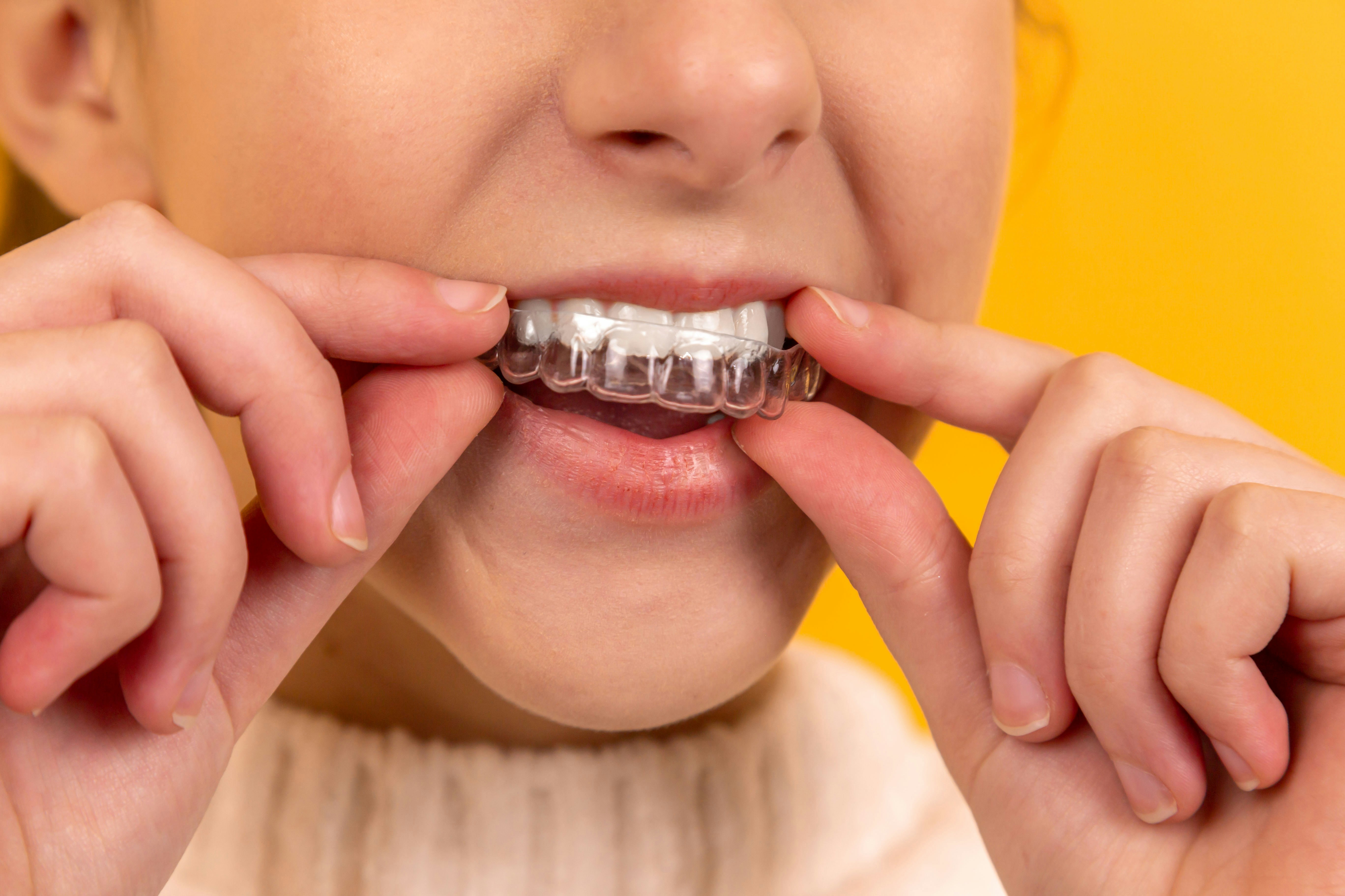 Aligners (Go – Clipless)