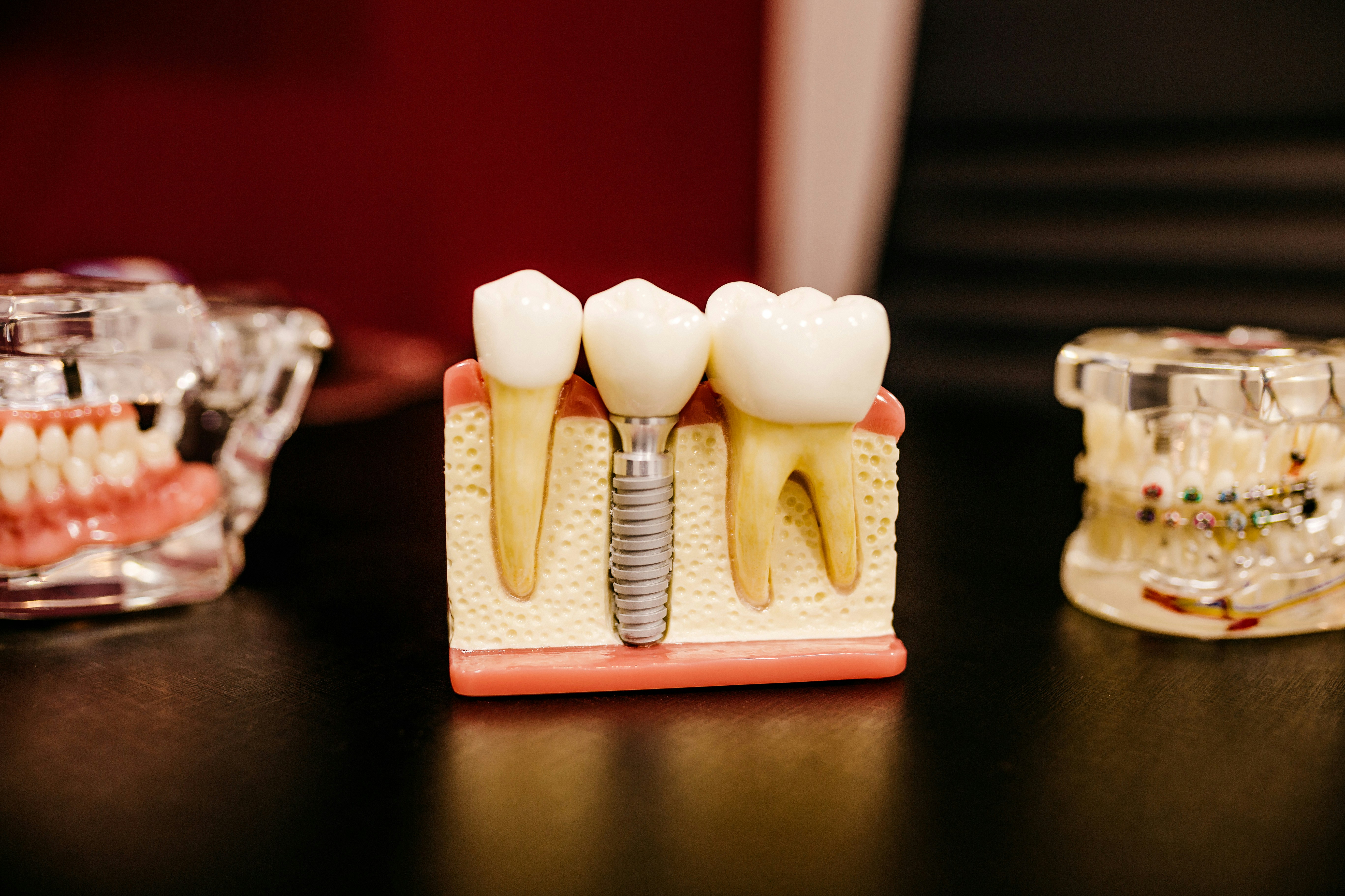 Advanced Dental Implants