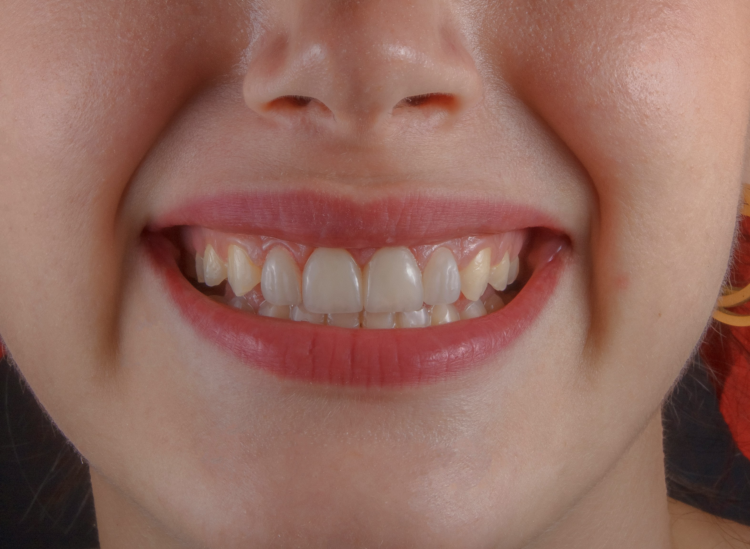 Smile Designing