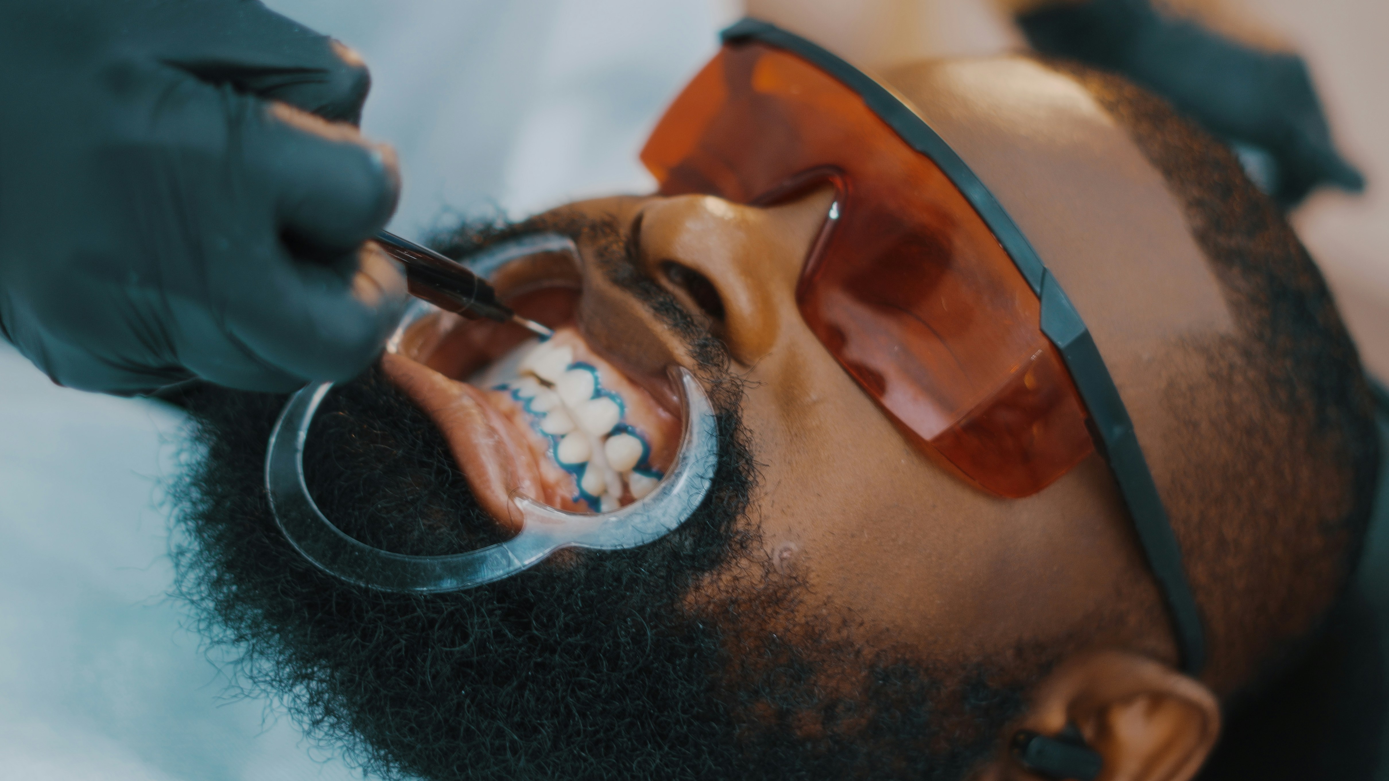Teeth Whitening